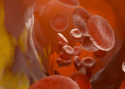 Assessing Your Risk of Cardiovascular Disease (Video)