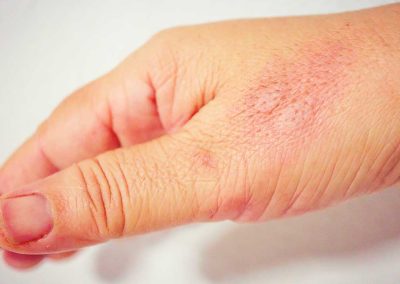 What Is Inflammation? How the Body Responds, From Stings to Vaccinations
