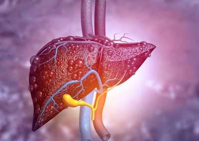 Silent Liver Disease