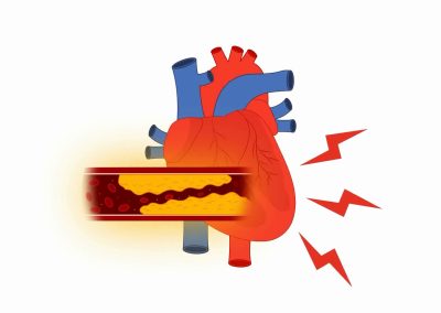 The Chief Villain in the Story of Cardiovascular Disease isn’t Cholesterol (Video)